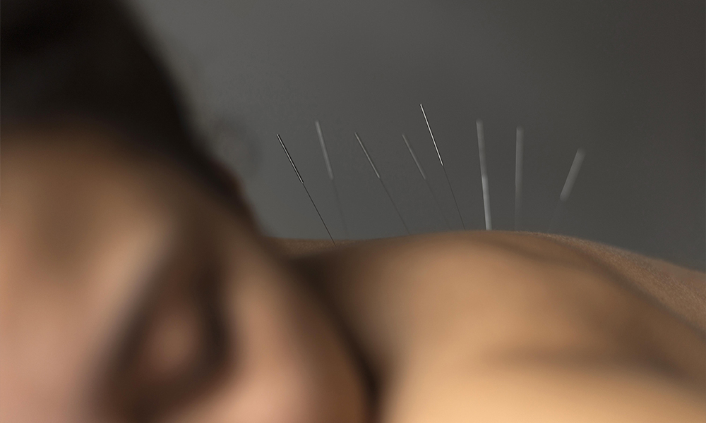 acupuncture